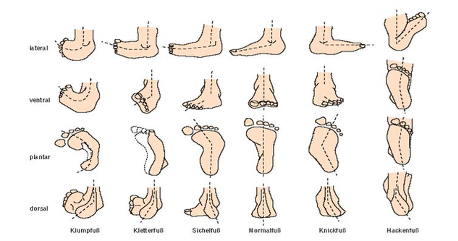 Fußfehlstellungen 