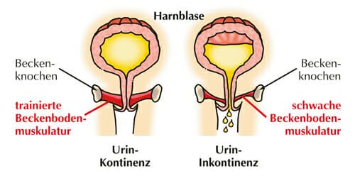 Inkontinenz Beckenbodentraining