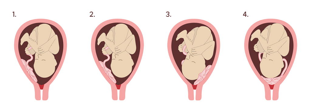 Diagnose Placenta praevia